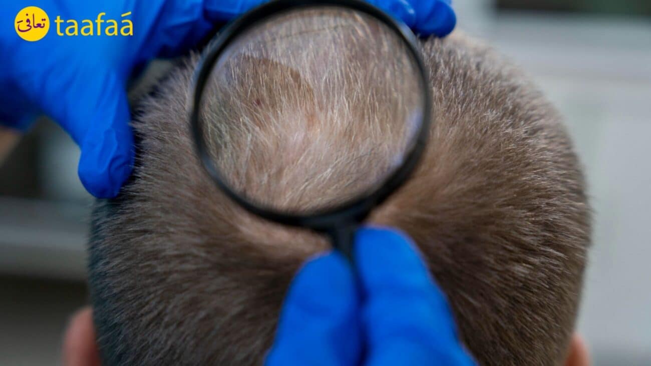 علاج تساقط الشعر في سلطنة عمان 