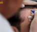زراعة الشعر في مسقط